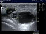 УЗИ коленного сустава.